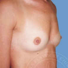 plastick� chirurgie-prsn� implant�ty