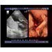 3D/4D ultrazvukov vyeten plodu