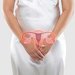 Endometriza stoj za neplodnost u en. Jde vbec vylit?