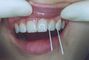 Zachrnn zuby  bezbolestn a bez vrtn 