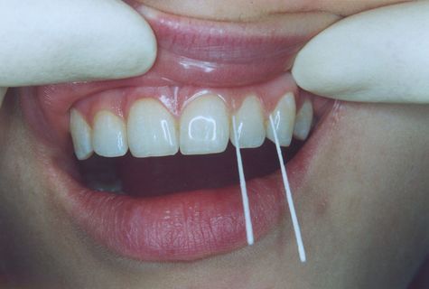 FOTKA - Zachrnn zuby  bezbolestn a bez vrtn 