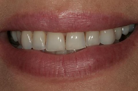 FOTKA - Dentln perky - Dejte svmu chrupu punc luxusu!