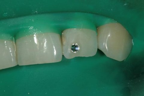 FOTKA - Dentln perky - Dejte svmu chrupu punc luxusu!