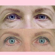 Blefaroplastika - operace horních a dolních víček Blefaroplastika - operace horních a dolních víček