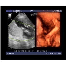 ultrazvukov foto