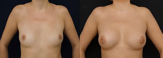 augmentace prsou