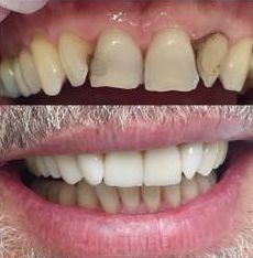 ukzka - rekonstrukce zub