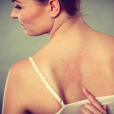 Nová léčba atopické dermatitidy uleví od svědění do pár dnů Nová léčba atopické dermatitidy uleví od svědění do pár dnů