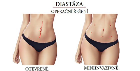Diastáza - operace