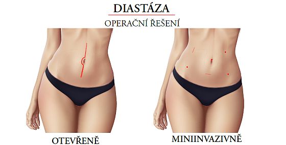 Diastáza - operace Diastáza - operace