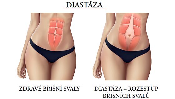 diastáza