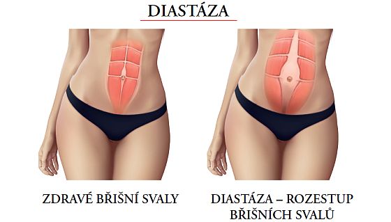 diastáza diastáza