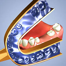 titanov zubn implantty